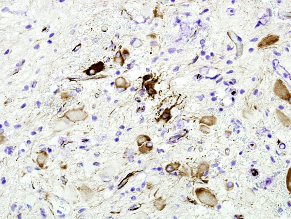 5D8 Tuberous Sclerosis (Case 5) Nestin 9A