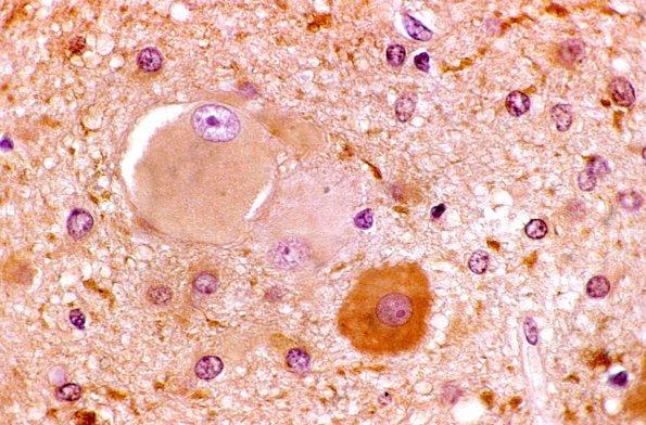 6 Tuberous sclerosis (Case 6) 3 NSE