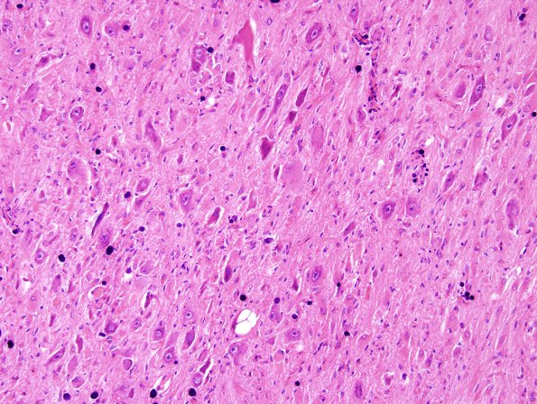 7A2 Tuberous Sclerosis (Case 7) H&E 1