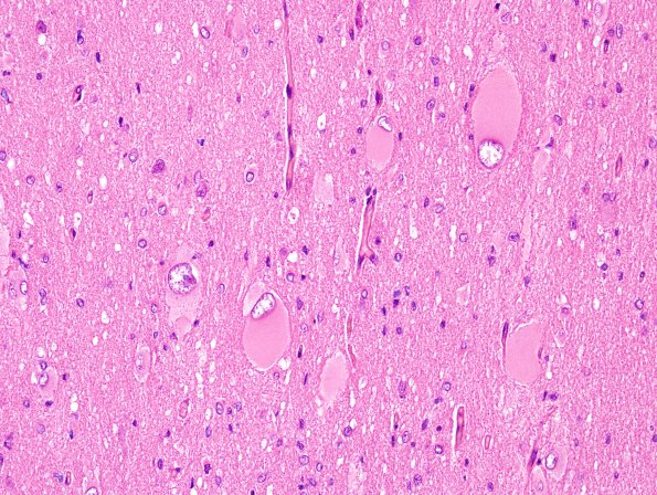 7A3 Tuberous Sclerosis (Case 7) H&E 5A