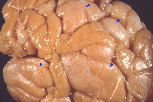 8A1 Tuberous sclerosis (Case 8) 2