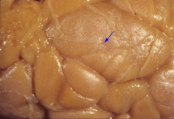 8A2 Tuberous sclerosis (Case 8) 5