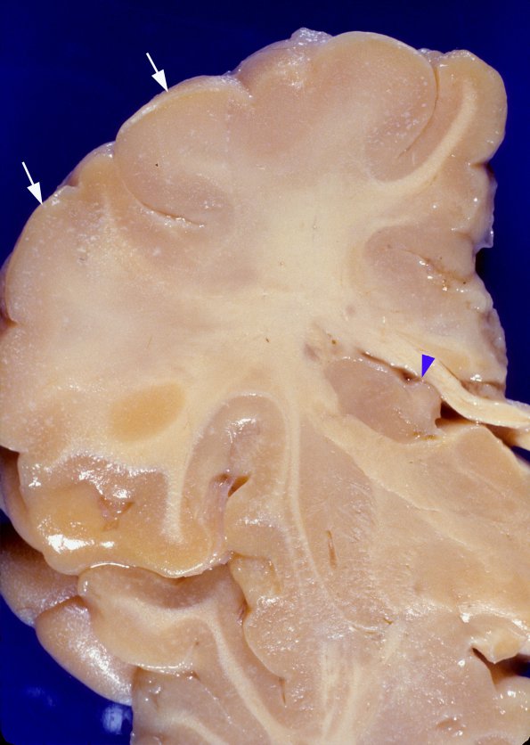 8A3 Tuberous sclerosis (Case 8) 3