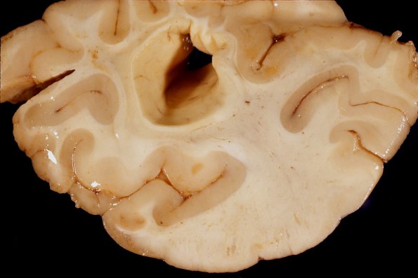 8A4 Tuberous sclerosis (Case 8) 4