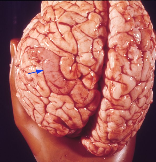 9 Tuberous sclerosis (Case 9)