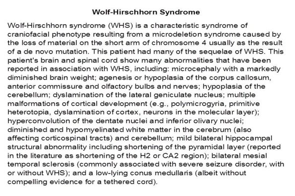 0A Wolf-Hirschhorn Syndrome