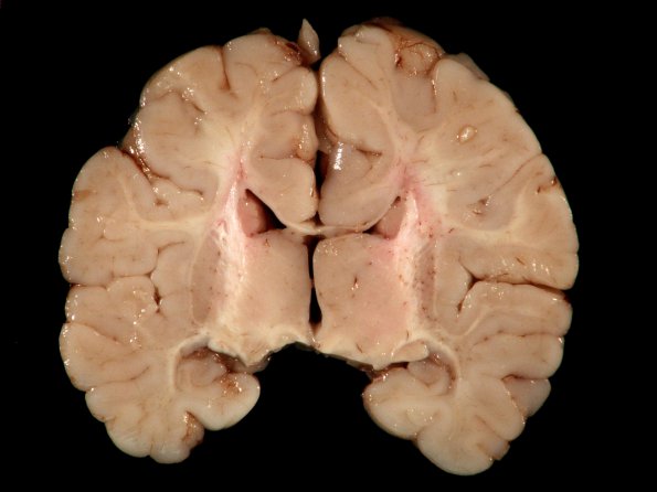 1A1 Wolf-Hirschhorn Syndrome (Case 1) Gross_3