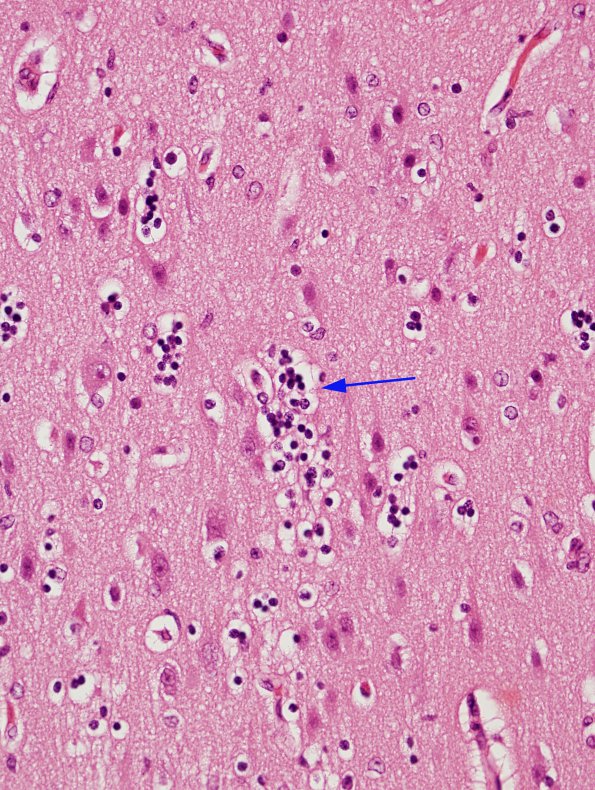 1B3 Wolf-Hirschhorn Syndrome (Case 1) H&E 7