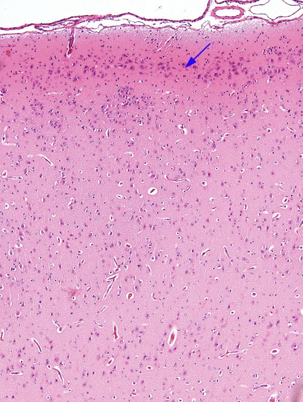 1B4 Wolf-Hirschhorn Syndrome (Case 1) H&E 8