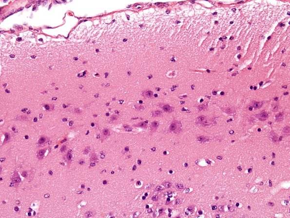 1B5 Wolf-Hirschhorn Syndrome (Case 1) H&E 10