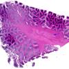 1C1 Wolf-Hirschhorn Syndrome (Case 1) H&E whole mount 1