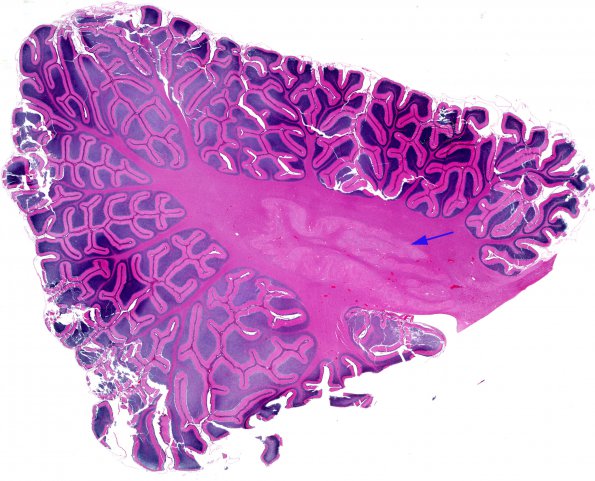 1C1 Wolf-Hirschhorn Syndrome (Case 1) H&E whole mount 1