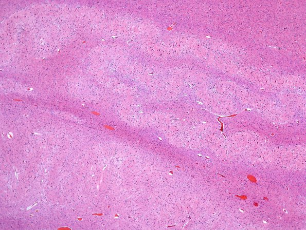 1C3 Wolf-Hirschhorn Syndrome (Case 1) H&E cerebellum 1