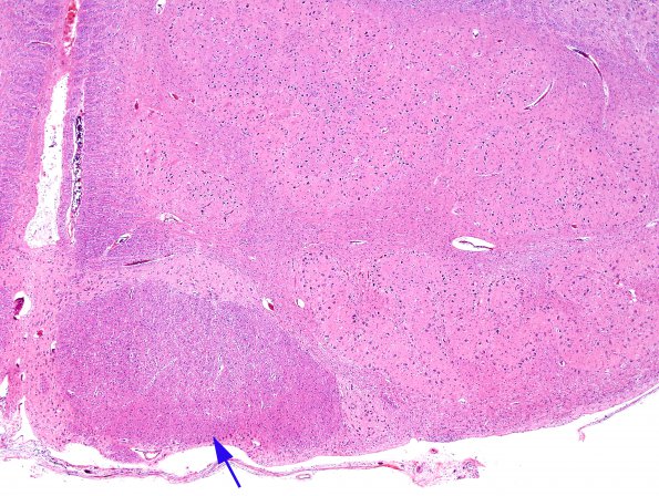 1D Wolf-Hirschhorn Syndrome (Case 1) H&E pyramid & ION 1