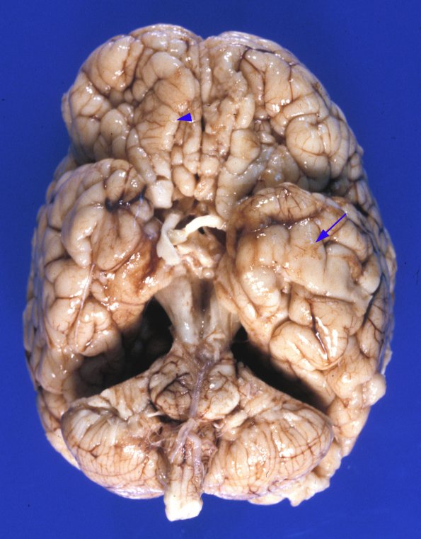 1A1 Zellweger Cerebrohepatorenal Syndrome (Case 1) 15