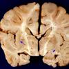 1A2 Zellweger Cerebrohepatorenal Syndrome (Case 1) 6