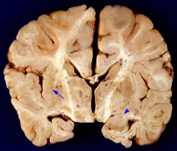 1A2 Zellweger Cerebrohepatorenal Syndrome (Case 1) 6