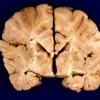 1A3 Zellweger Syndrome (Case 1) A2 (2)