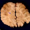 1A4 Zellweger Syndrome (Case 1) A17 (2)