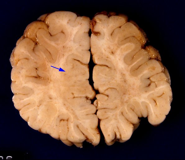 1A4 Zellweger Syndrome (Case 1) A17 (2)