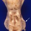 1A5 Zellweger Cerebrohepatorenal Syndrome (Case 1) 8 dorsal brainstem