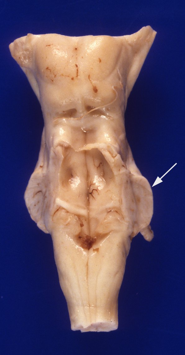 1A5 Zellweger Cerebrohepatorenal Syndrome (Case 1) 8 dorsal brainstem