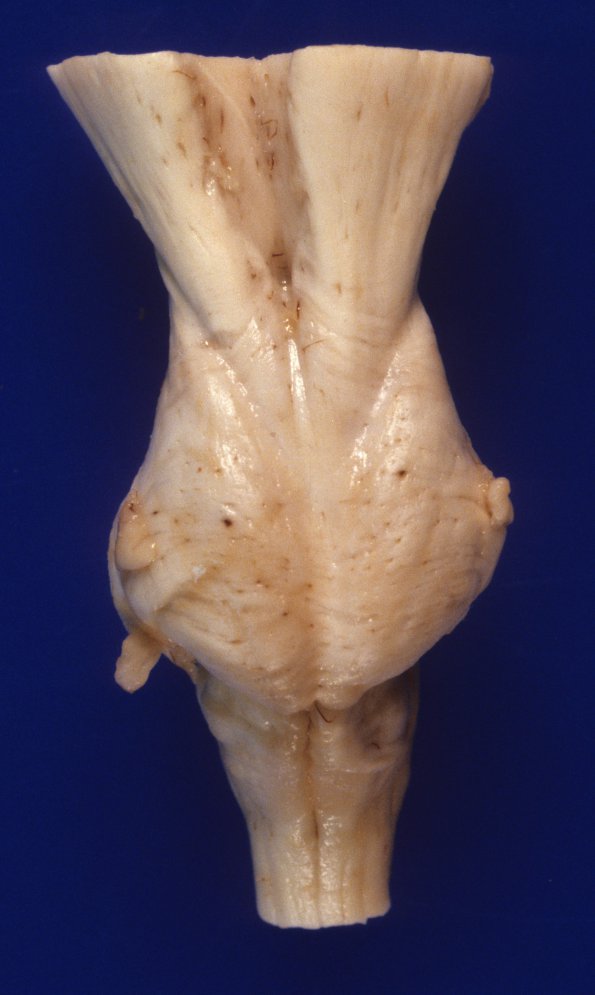 1A6 Zellweger Cerebrohepatorenal Syndrome (Case 1) 11 ventral brainstem