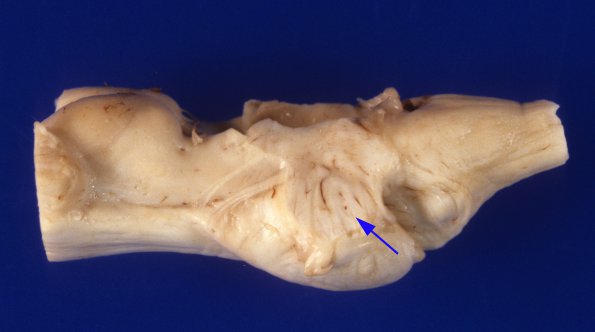 1A7 Zellweger Cerebrohepatorenal Syndrome (Case 1) 10 lateral brainstem