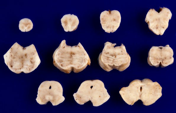 1A8 Zellweger Cerebrohepatorenal Syndrome (Case 1) 2