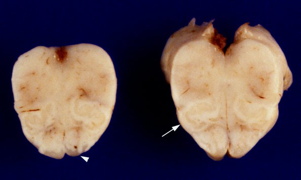 1A9 Zellweger Cerebrohepatorenal Syndrome (Case 1) 12 PMG, dec WM