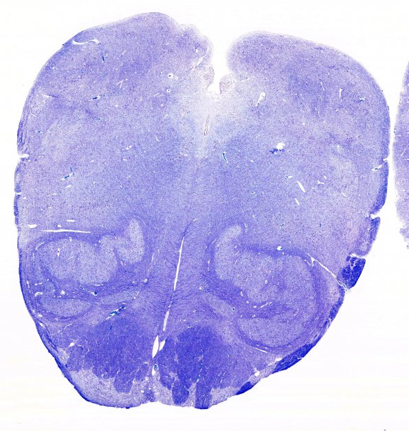 1B2 Zellweger Syndrome (Case 1) Nissl 1 (2)