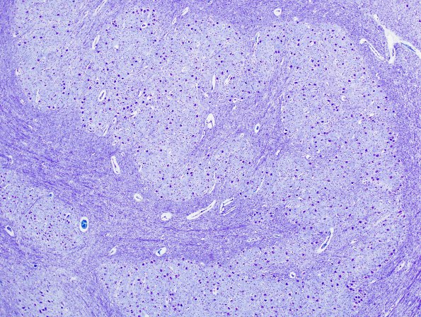 1B3 Zellweger Cerebrohepatorenal Syndrome (Case 1) ION 2