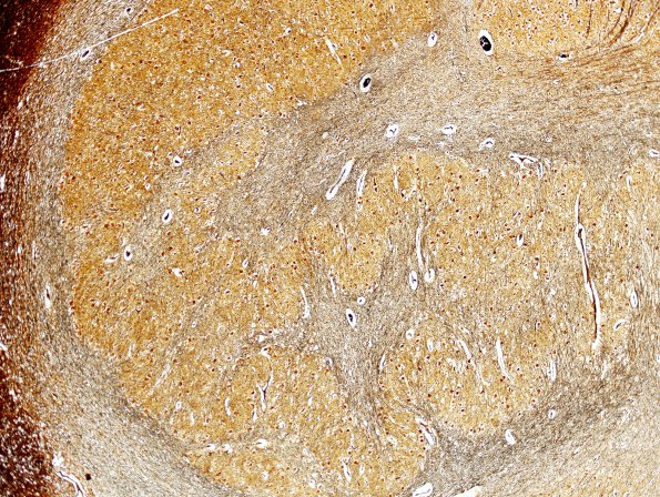 1B5 Zellweger Cerebrohepatorenal Syndrome (Case 1) ION 3