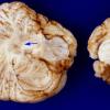 1C1 Zellweger Cerebrohepatorenal Syndrome (Case 1) 14