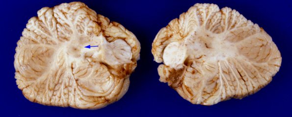 1C1 Zellweger Cerebrohepatorenal Syndrome (Case 1) 14