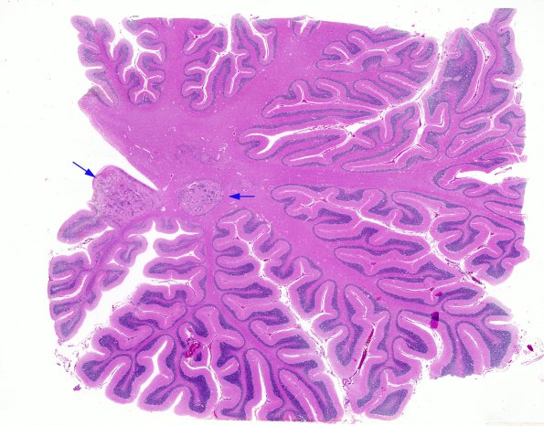 1C2 Zellweger Cerebrohepatorenal Syndrome (Case 1) H&E whole mount 1