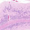 1C6 Zellweger Cerebrohepatorenal Syndrome (Case 1) H&E 1