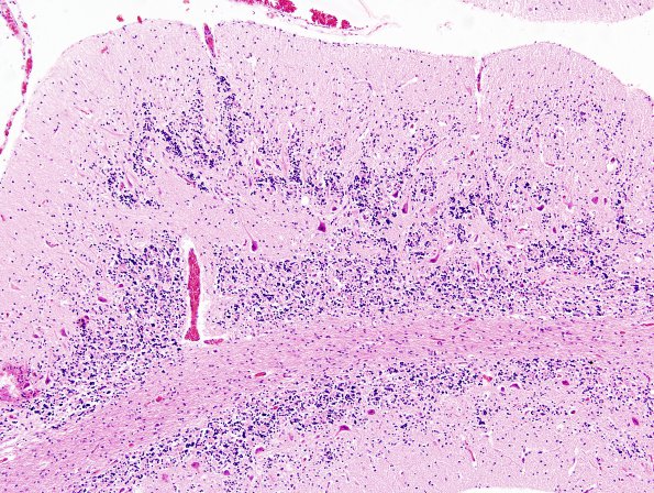 1C6 Zellweger Cerebrohepatorenal Syndrome (Case 1) H&E 1