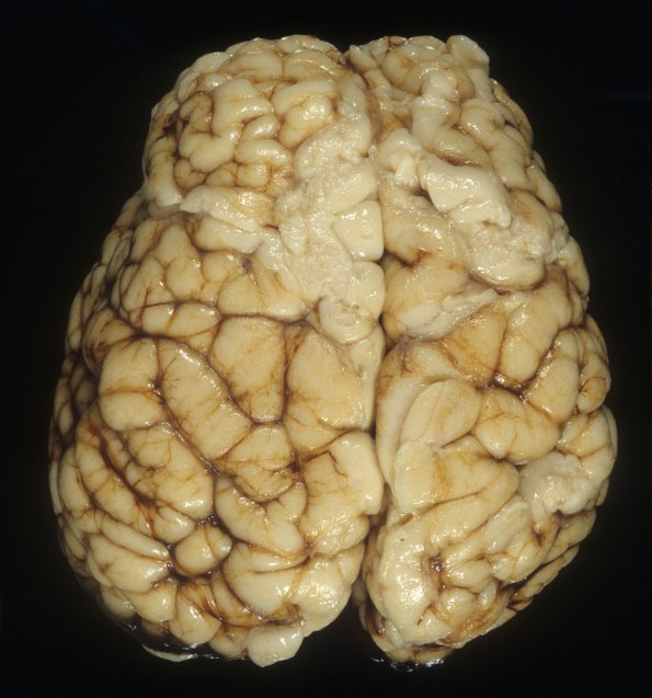 2A1 Zellweger Cerebrohepatorenal Syndrome (Case 2) 2