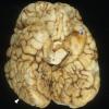 2A2 Zellweger Cerebrohepatorenal Syndrome (Case 2) 4