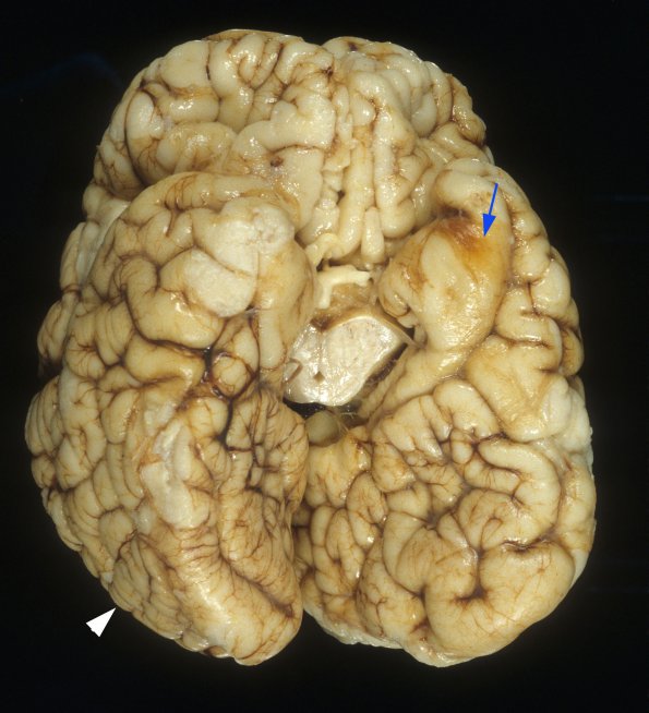 2A2 Zellweger Cerebrohepatorenal Syndrome (Case 2) 4