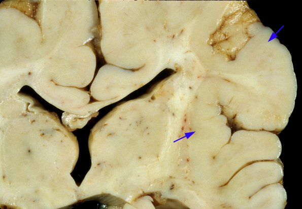 2A3 Zellweger Cerebrohepatorenal Syndrome (Case 2) 3