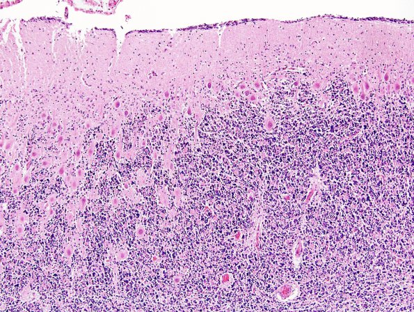 2B7 Zellweger Cerebrohepatorenal Syndrome (Case 2) N9 10X 2