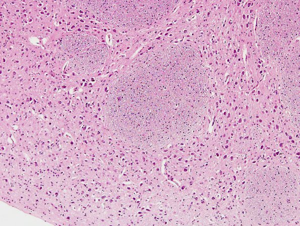 2C3 Zellweger Cerebrohepatorenal Syndrome (Case 2) N8 pyramid H&E