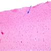 Astrocytosis, subpial (Chaslin)