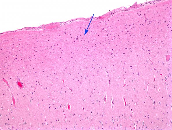 1A1 Astrocytosis, Subpial  (Chaslin, Case 1) 1 H&E 1