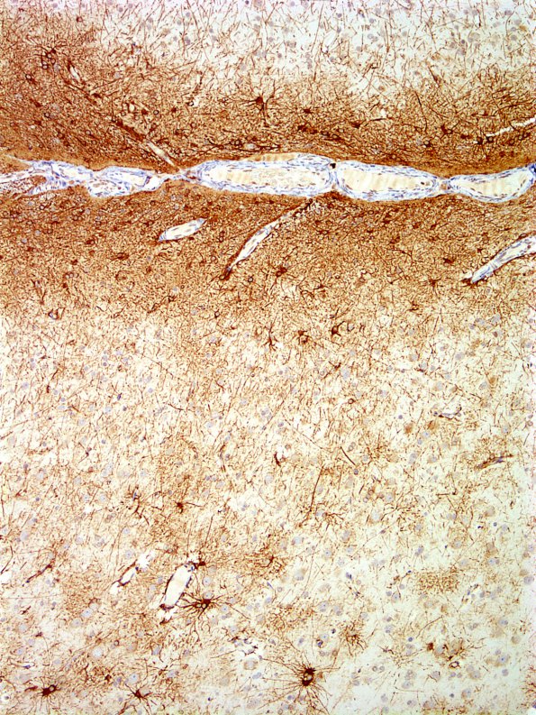 1A2 Astrocytosis, Subpial  (Chaslin, Case 1) GFAP 3