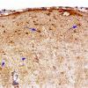 1A3 Astrocytosis, Subpial  (Chaslin, Case 1) GFAP 4