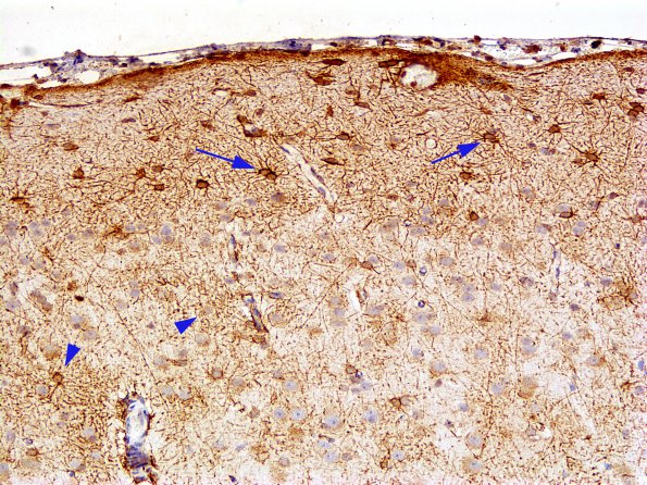 1A3 Astrocytosis, Subpial  (Chaslin, Case 1) GFAP 4