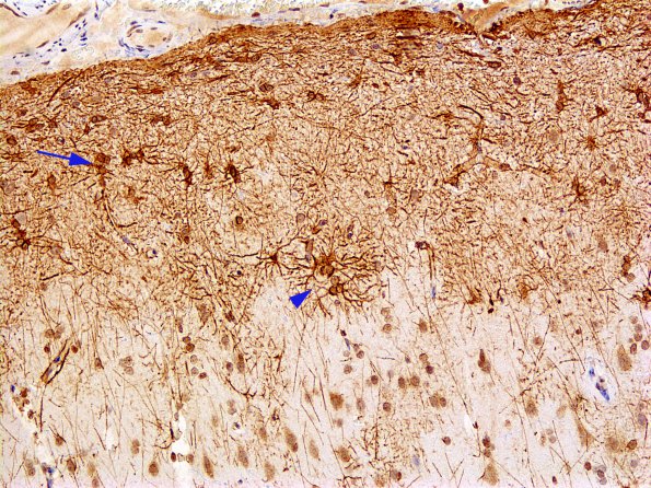 1A4 Astrocytosis, Subpial  (Chaslin, Case 1) GFAP 1